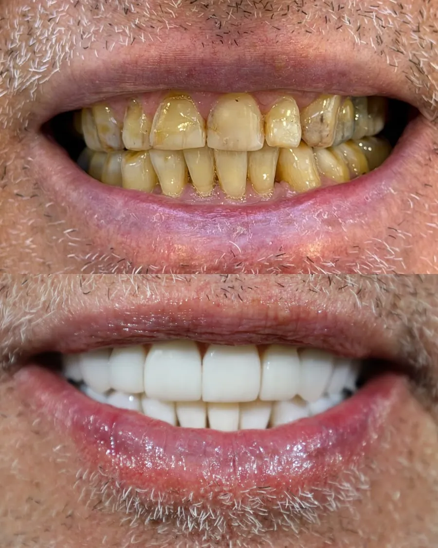 Lentes em resina, caso 1: sorriso antes (em cima) e depois (embaixo)