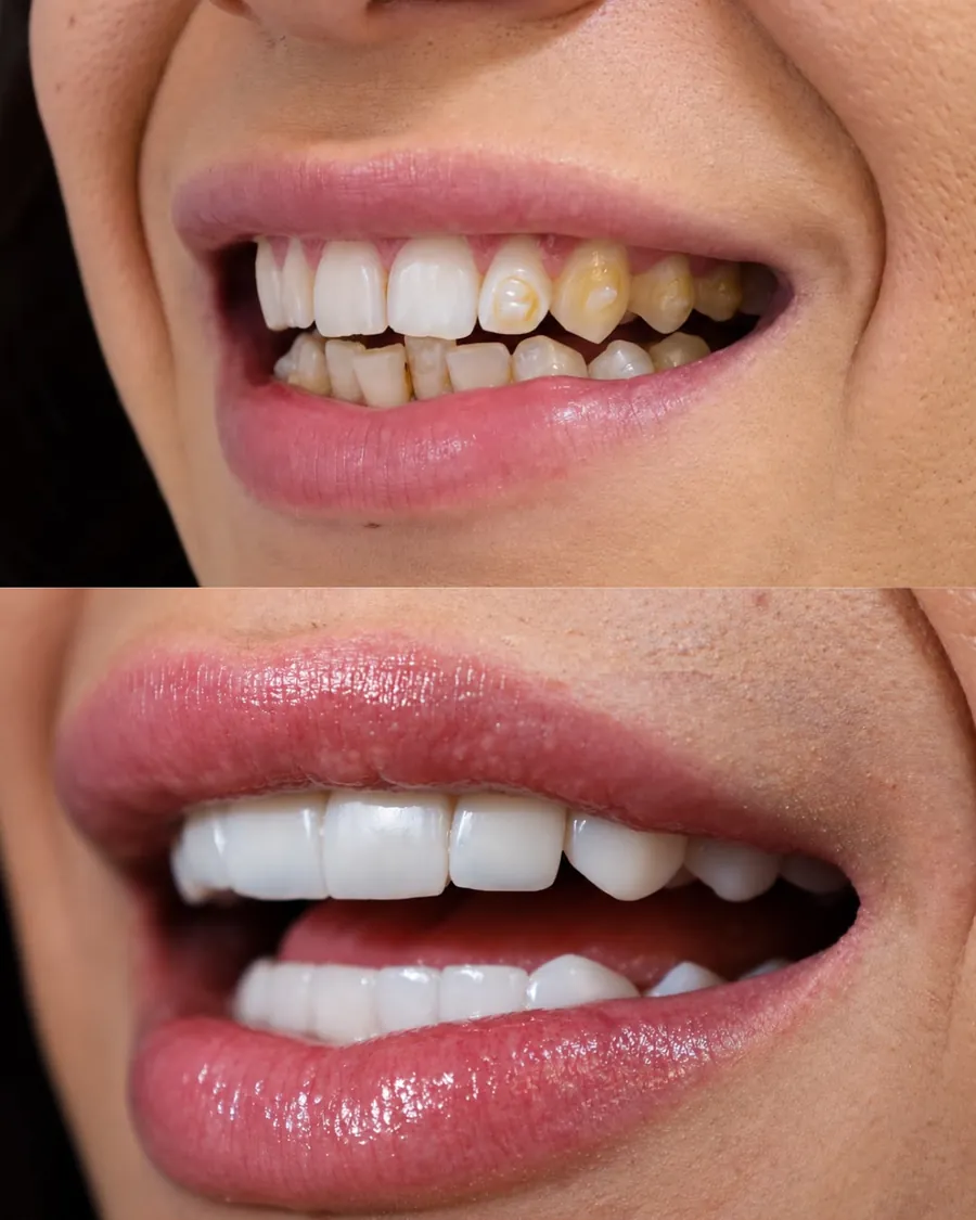 Lentes em resina, caso 10: sorriso antes (em cima) e depois (embaixo)