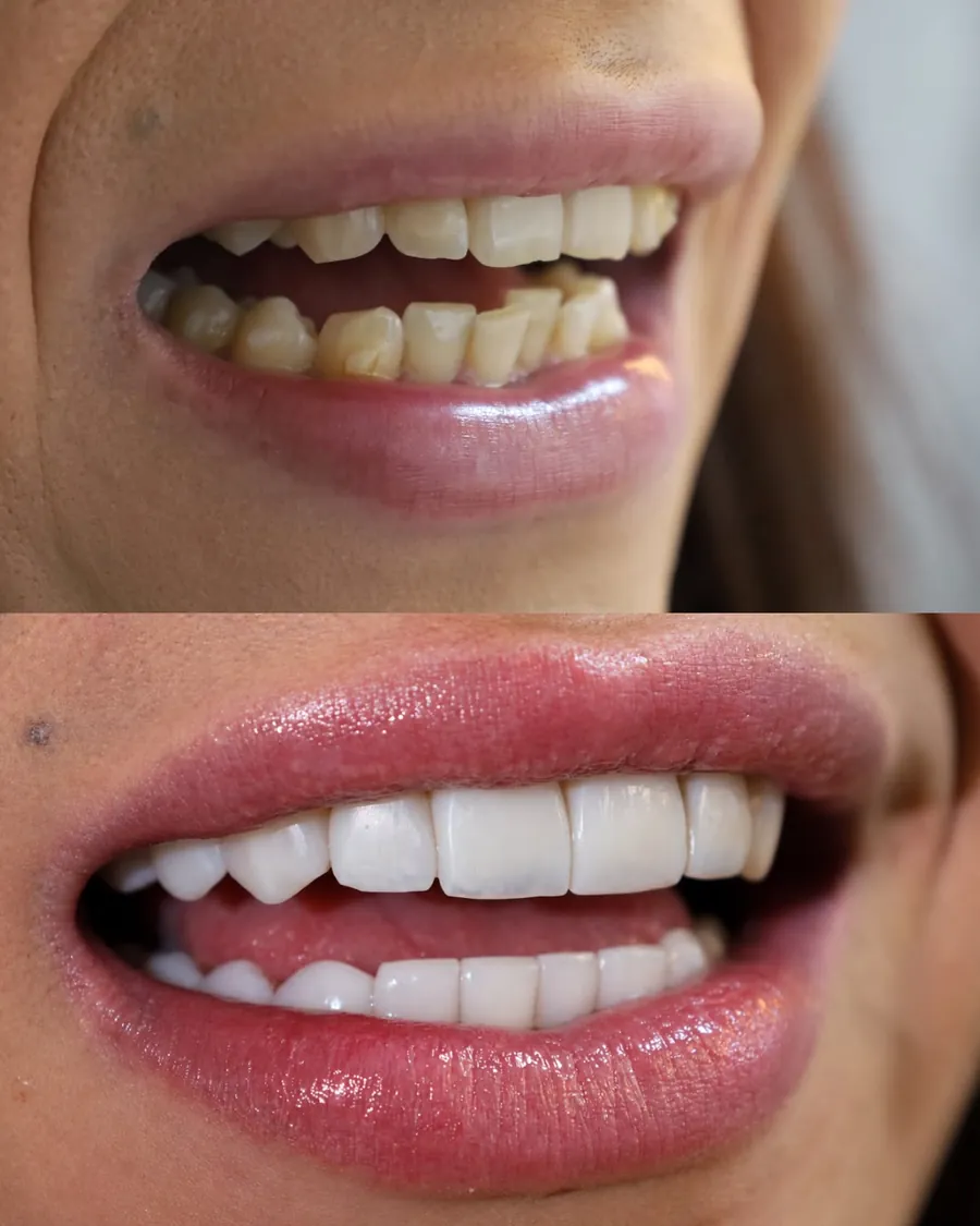 Lentes em resina, caso 6: sorriso antes (em cima) e depois (embaixo)