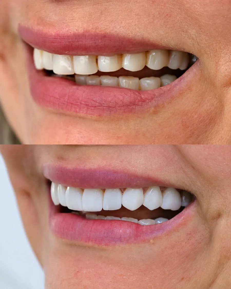 Lentes em resina, caso 7: sorriso antes (em cima) e depois (embaixo)