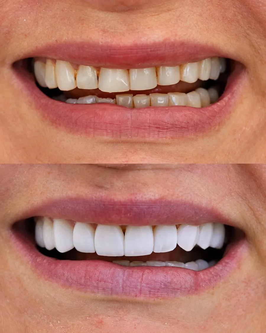 Lentes em resina, caso 8: sorriso antes (em cima) e depois (embaixo)