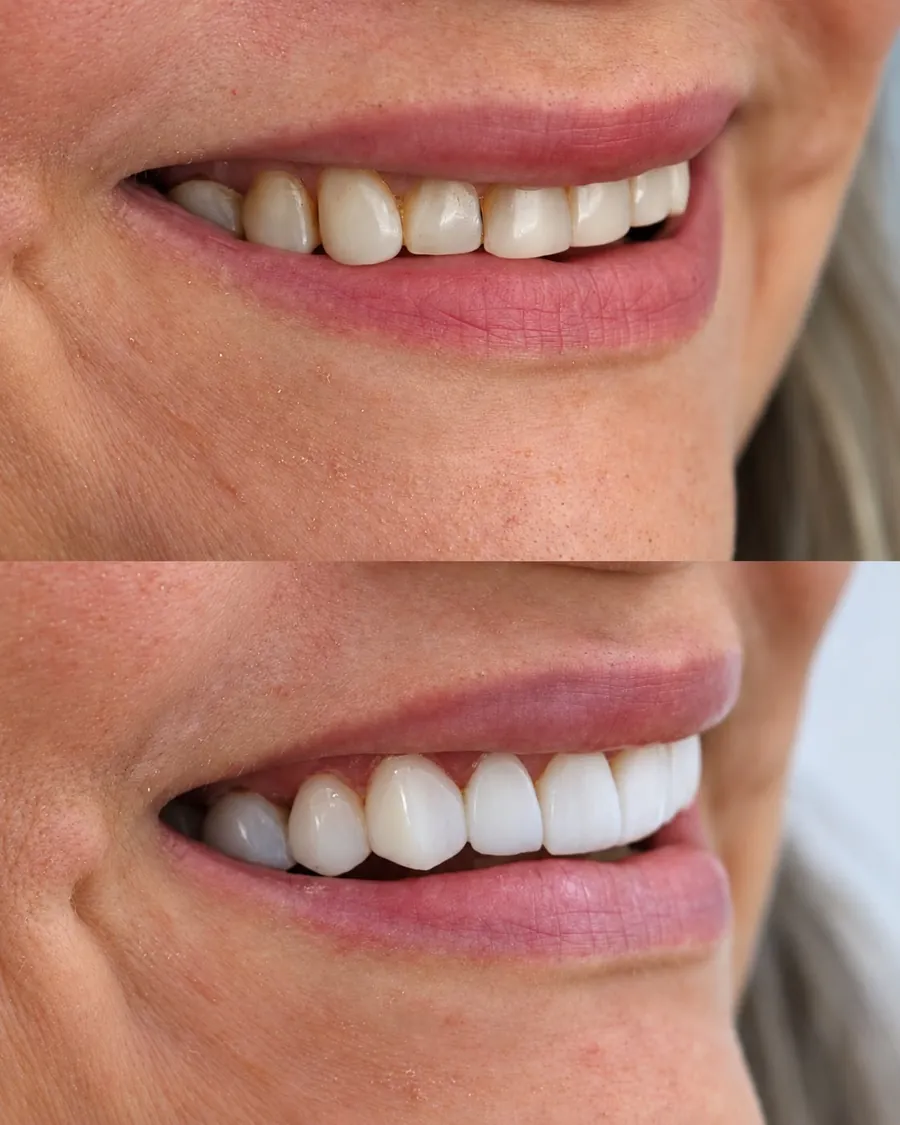 Lentes em resina, caso 9: sorriso antes (em cima) e depois (embaixo)
